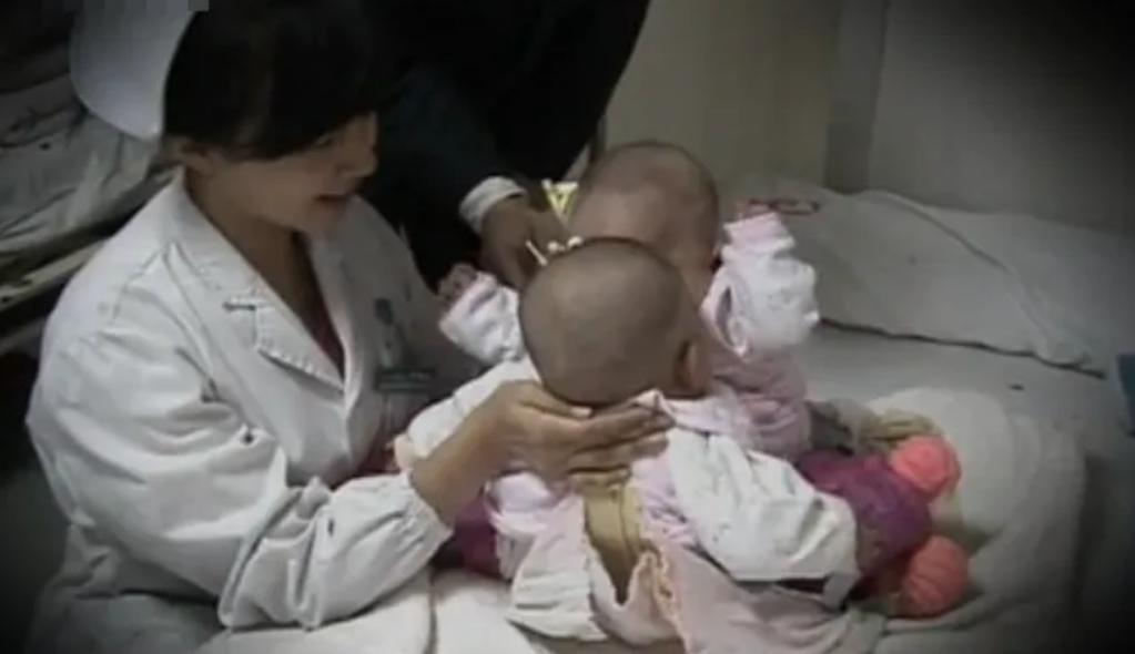 连体婴姐妹18年成功分离,连体婴姐妹成功分离后续