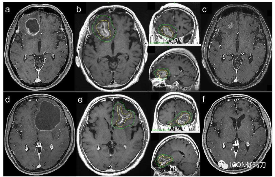 囊肿抽吸后分割伽玛刀放射外科治疗大的囊性脑转移瘤