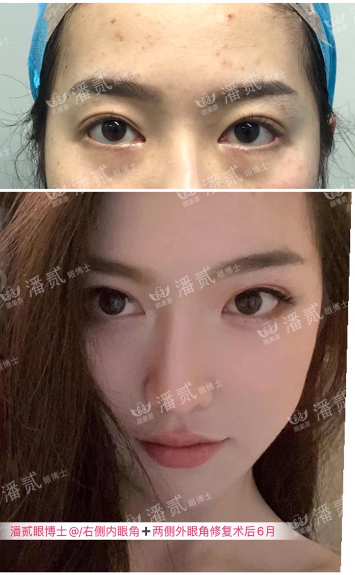 成都女子整容失败眼睛失明后续,整容眼角失败案例