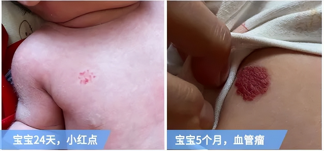 小孩哭闹血管瘤,宝宝血管瘤有什么危害