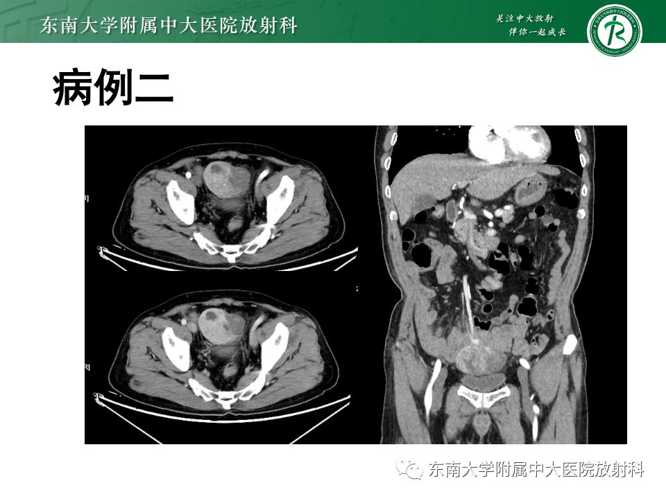 小肠间质瘤最新治疗中药方,小肠间质瘤基因检测