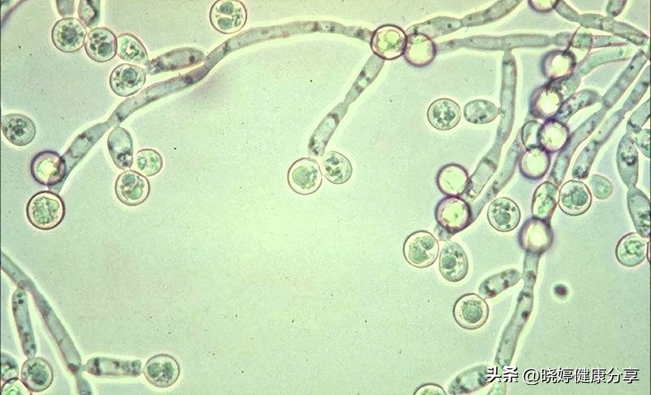 月经期间霉菌感染吃什么药,月经期间感染霉菌怎么治疗
