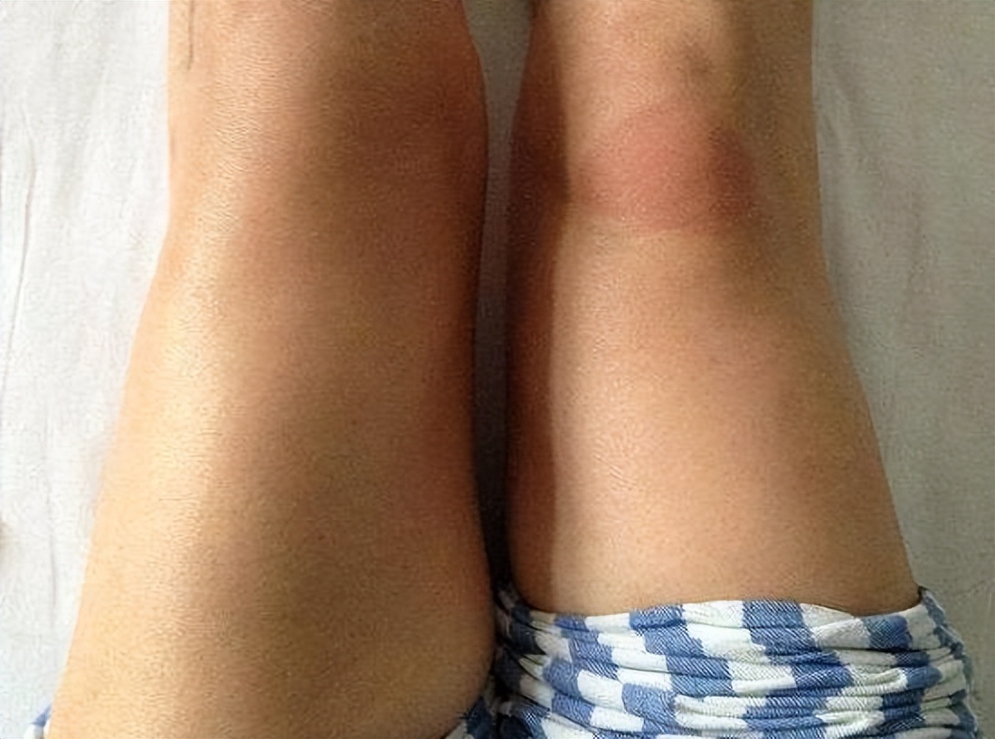 双腿不一样粗细怎么矫正,双腿粗细不一样是怎么回事