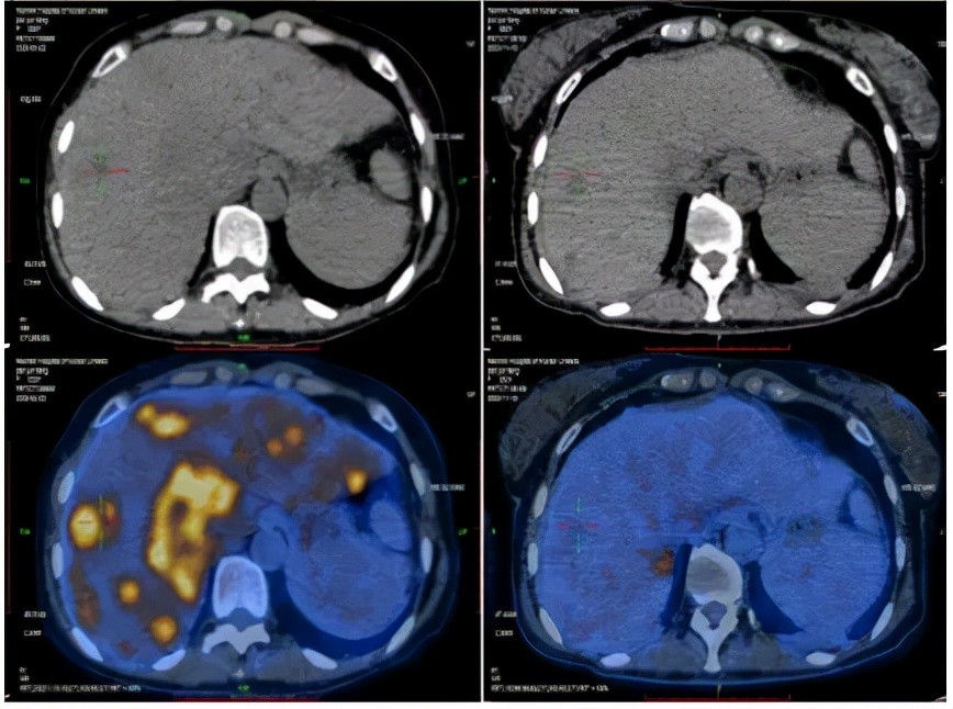 病例实录|免疫联合方案治疗胰腺癌多发转移的病例分享
