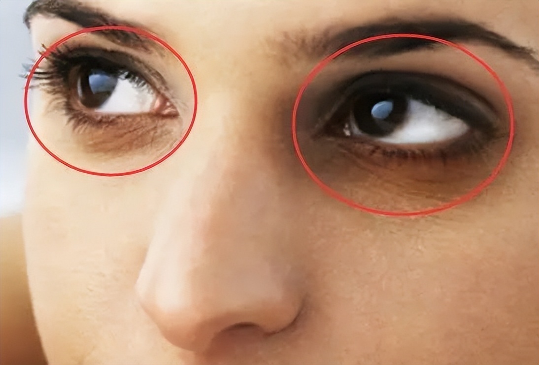 熬夜造成的老年斑长啥样,90后姑娘熬夜10年长老年斑谣言