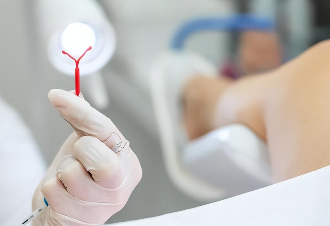 女人上环详细步骤,女性上环流程