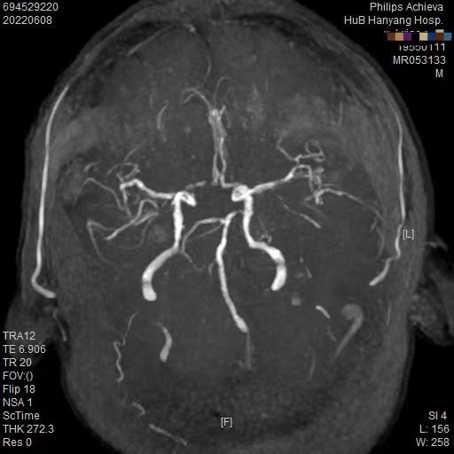 头晕怎么缓解眩晕,头晕和眩晕的区别警惕三种病