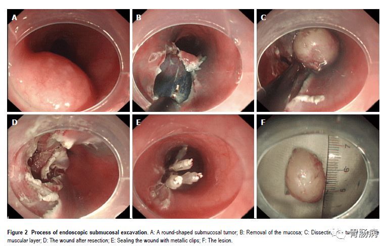 esd内镜下粘膜剥离几天可愈合,内镜下粘膜剥离术属于esd还是emr