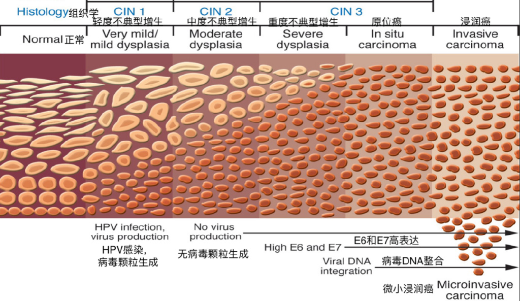 同样感染HPV，为什么有些人发展为宫颈癌，有些人却没事？
