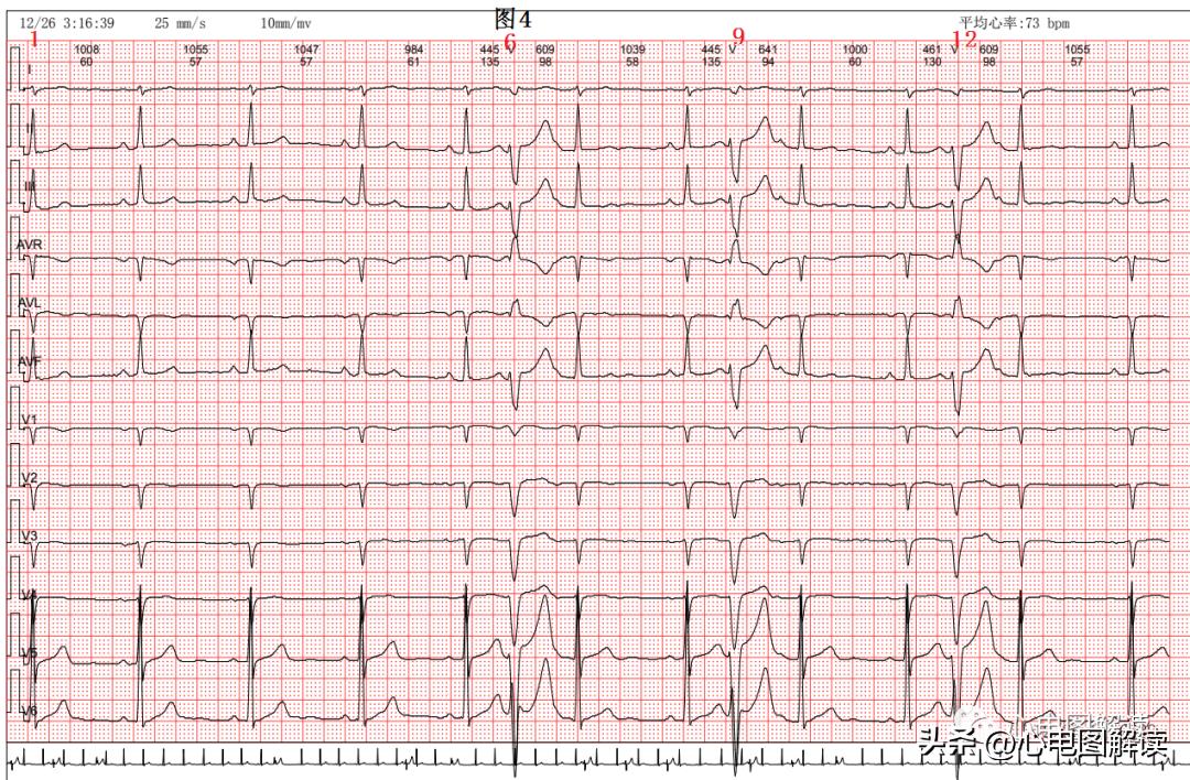 窦性心律偶见室性融合波,室性并行性心律