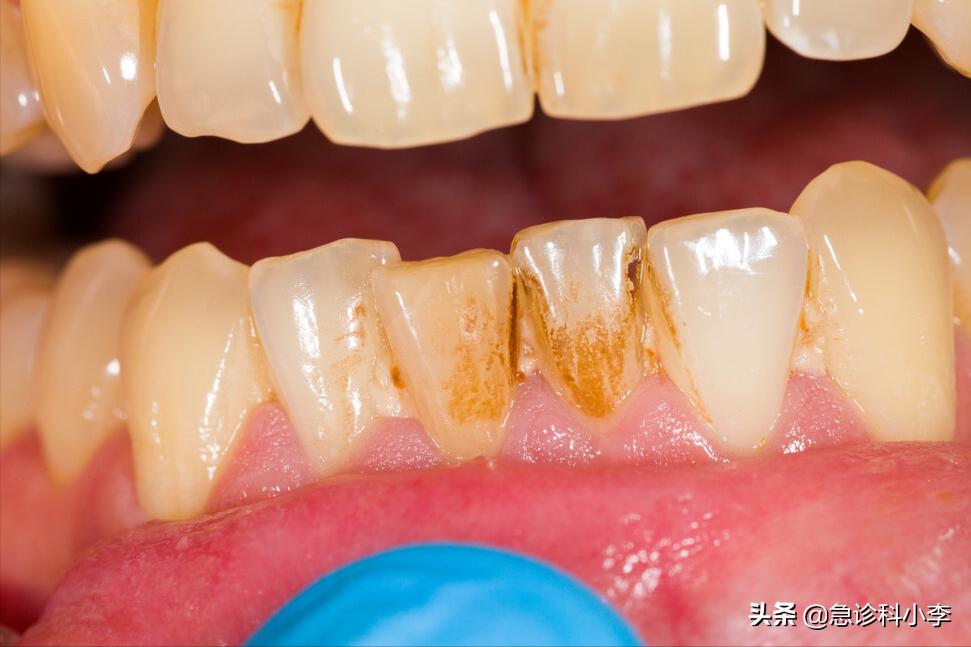 在牙缝里的牙结石要怎么去除,牙缝的牙结石怎么自己去除