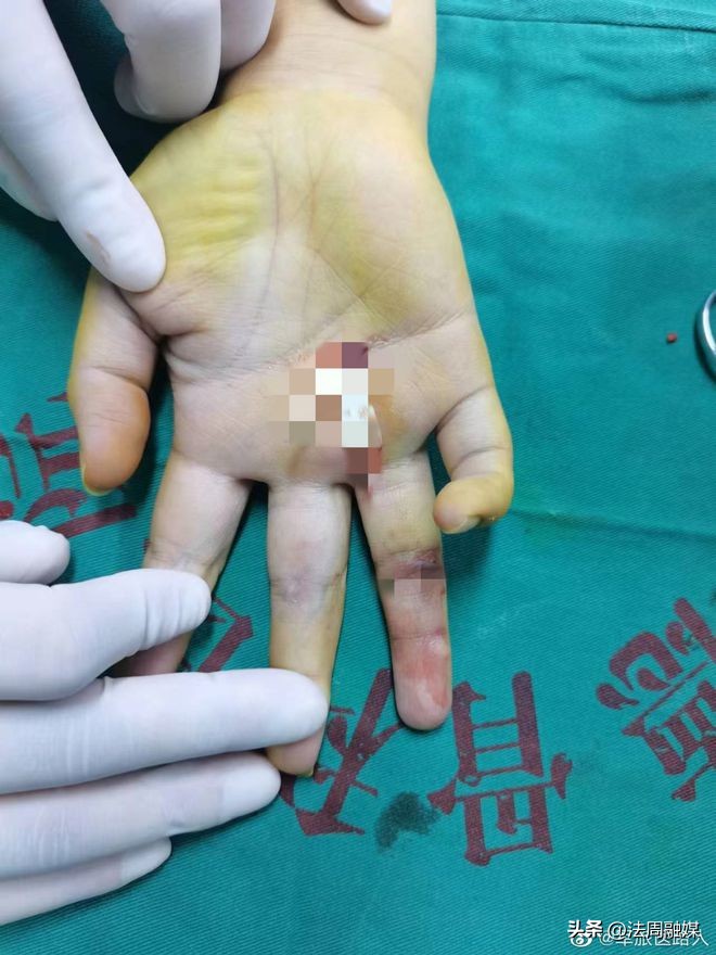 小伤口别害怕,小伤口大惊小怪