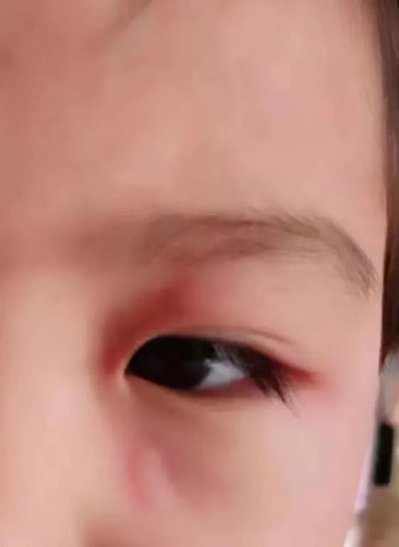 吃了退烧药过敏起皮疹严重吗,吃退烧药过敏还能吃吗