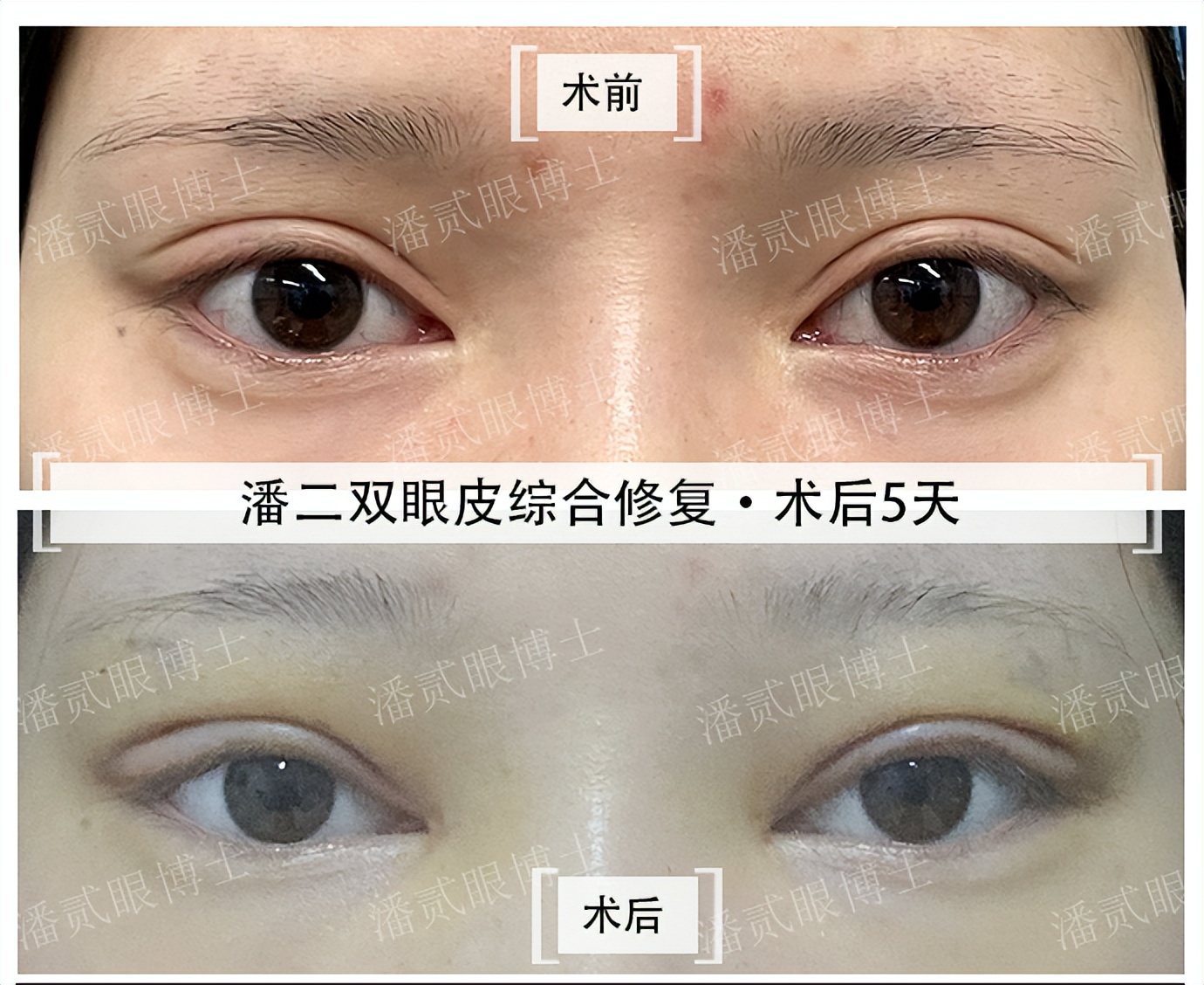 整容后眼睛不能闭合,整容失败眼睛无法闭合