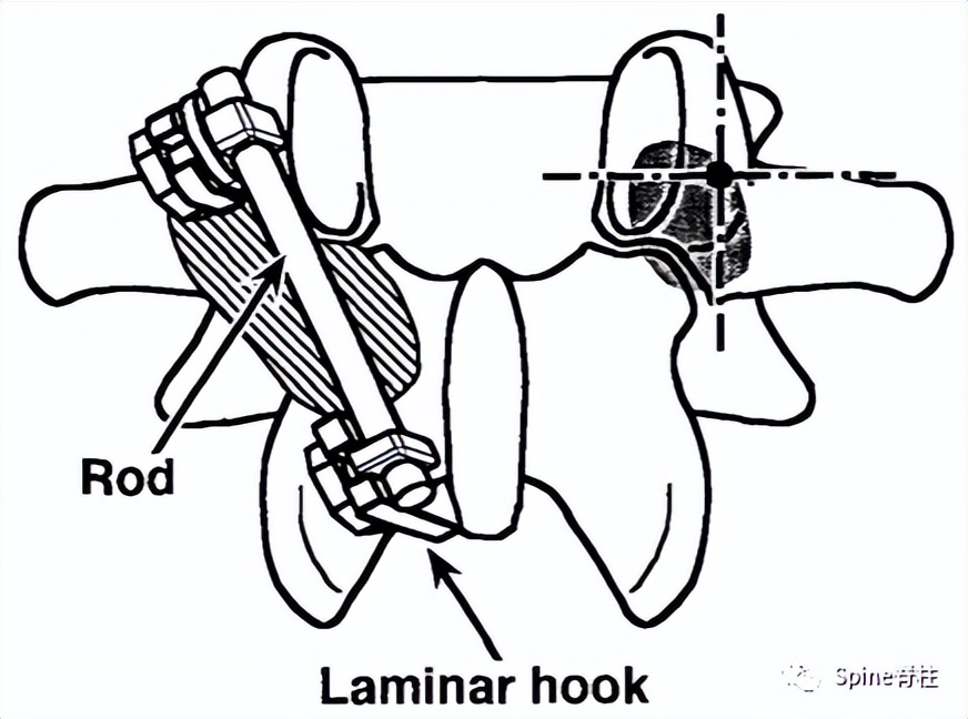 轻度峡部裂和重度峡部裂的区别,真性峡部裂和假性峡部裂