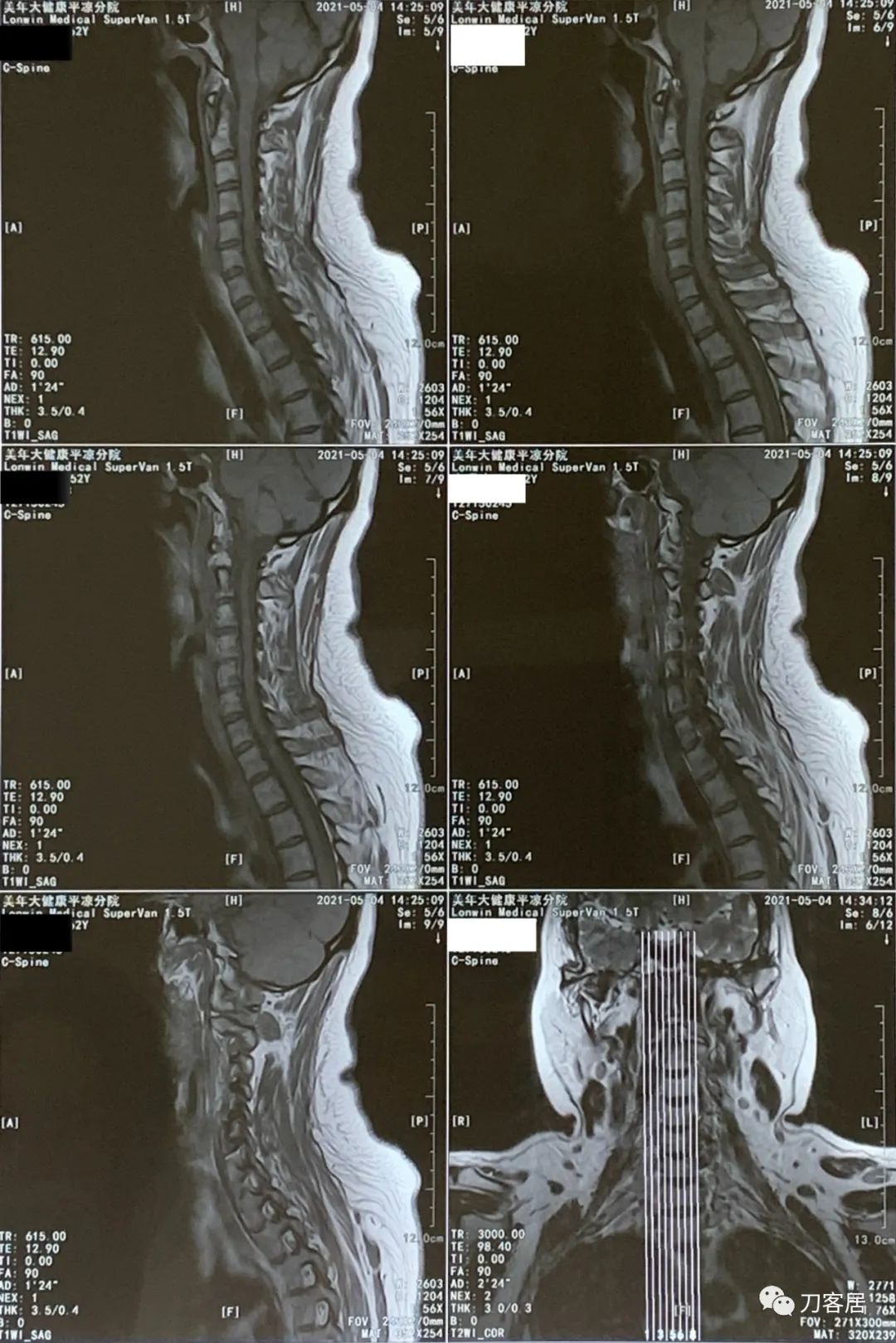 颈椎病十年了手臂酸痛肩背痛,颈椎病十年了一直痛怎么办