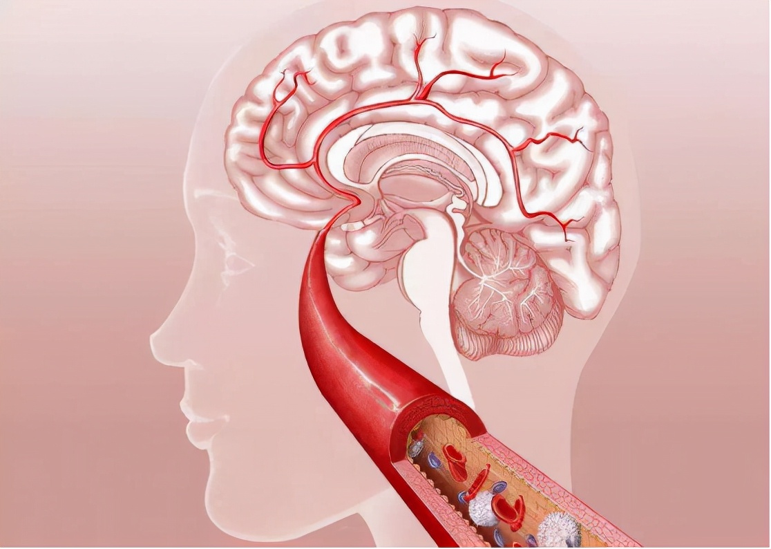 脑梗和脑出血的区别和原因,脑梗与大脑出血有什么区别