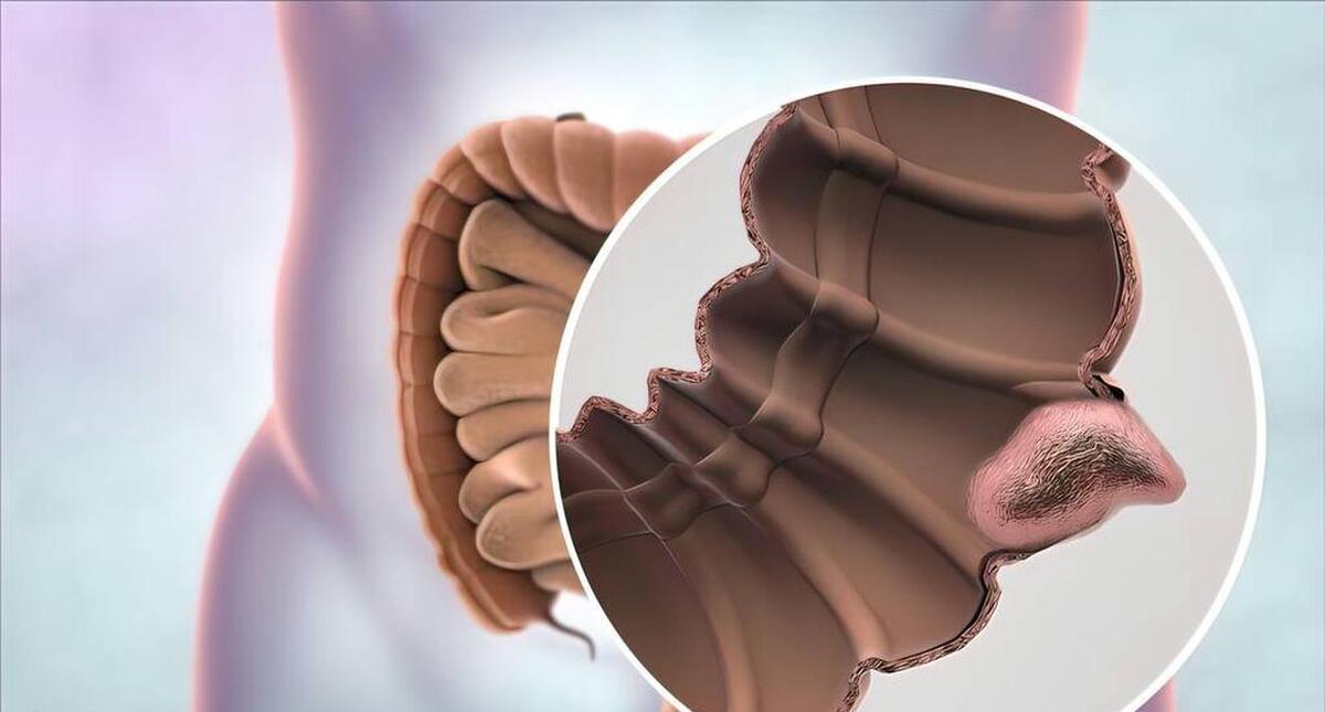 结直肠癌一般发病年龄,结直肠癌的诱因及病因