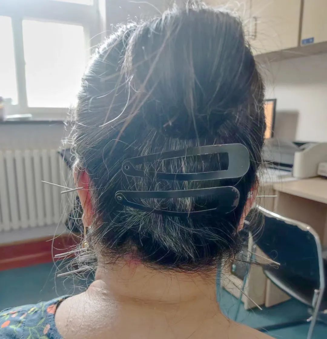 中医治疗特发性突聋的案例,治疗突聋的中医方案