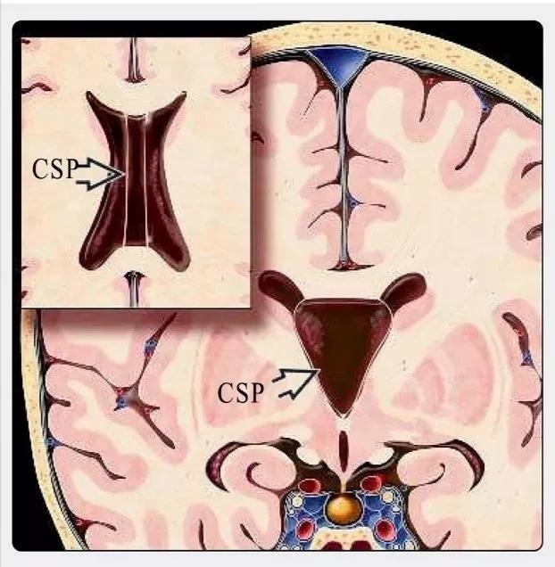 侧脑室就是透明隔腔吗,第五脑室是透明隔吗