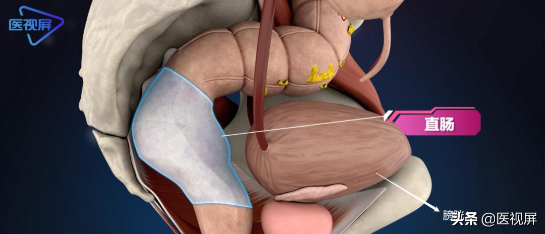 结肠肿瘤突变型多久长到15mm,直肠肿瘤长了23年