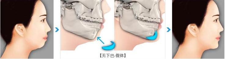 下巴不好看怎么自我改善,下巴不明显如何改善
