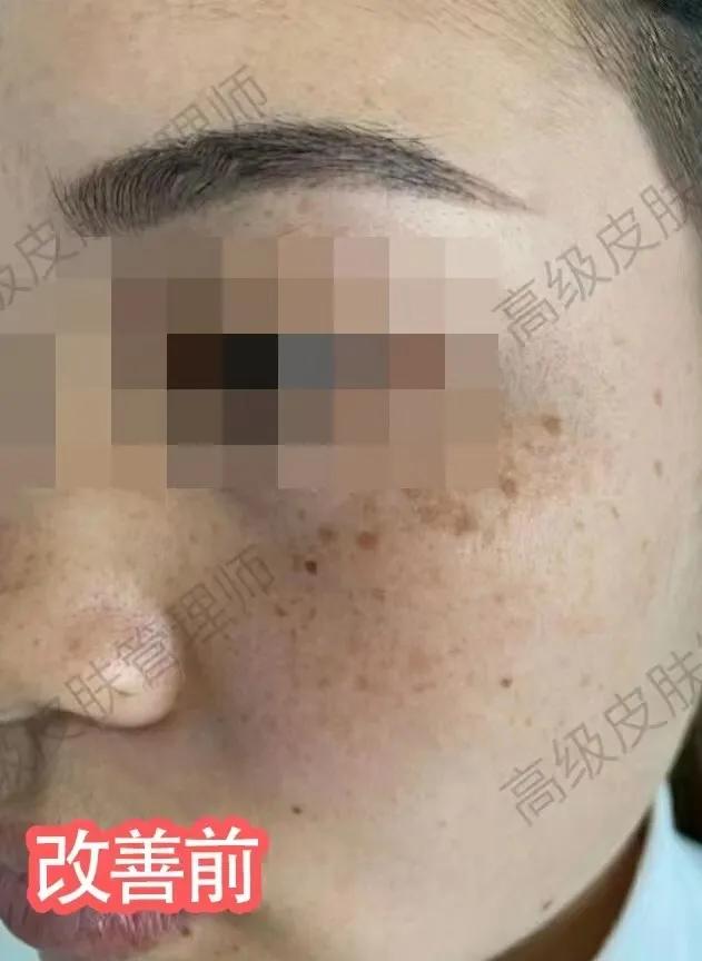 五天液氮冷冻祛斑亲身经历,千白氢醌乳膏祛斑亲身经历