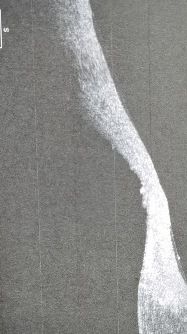 倒睫导致角膜溃疡怎么治疗,倒睫引起的角膜溃疡怎么治疗