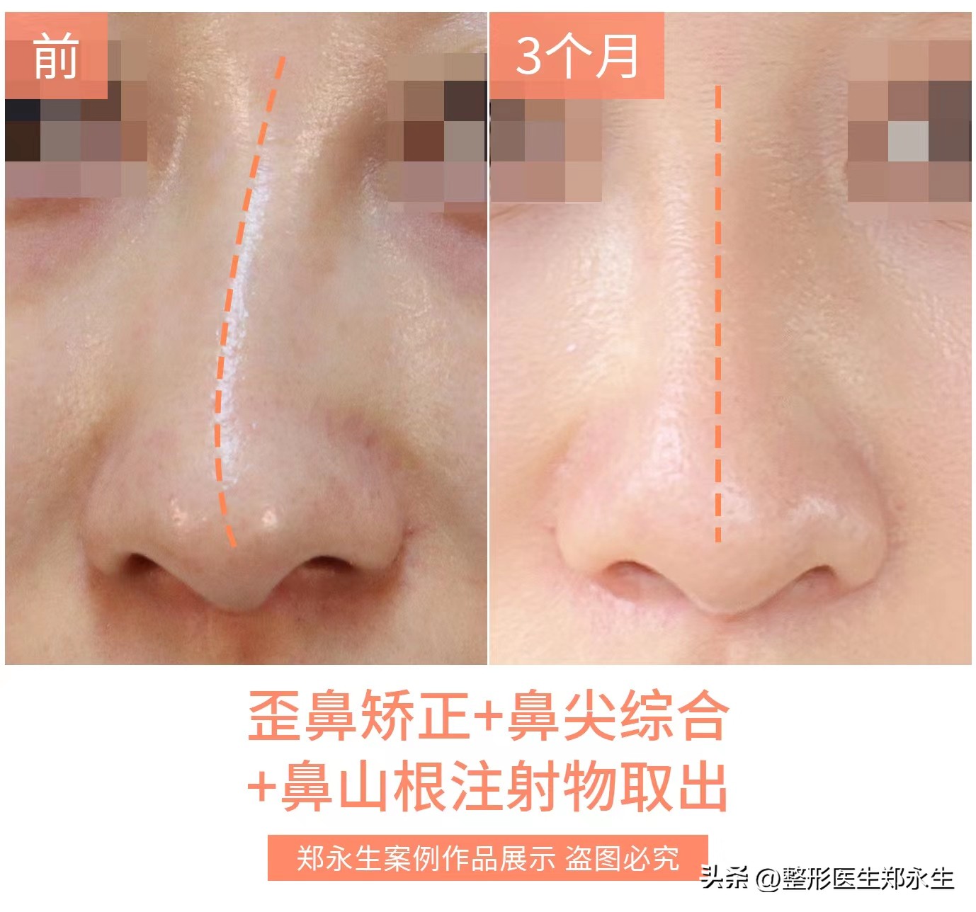 修复隆鼻不满意最佳取出时间,如何进行隆鼻失败修复