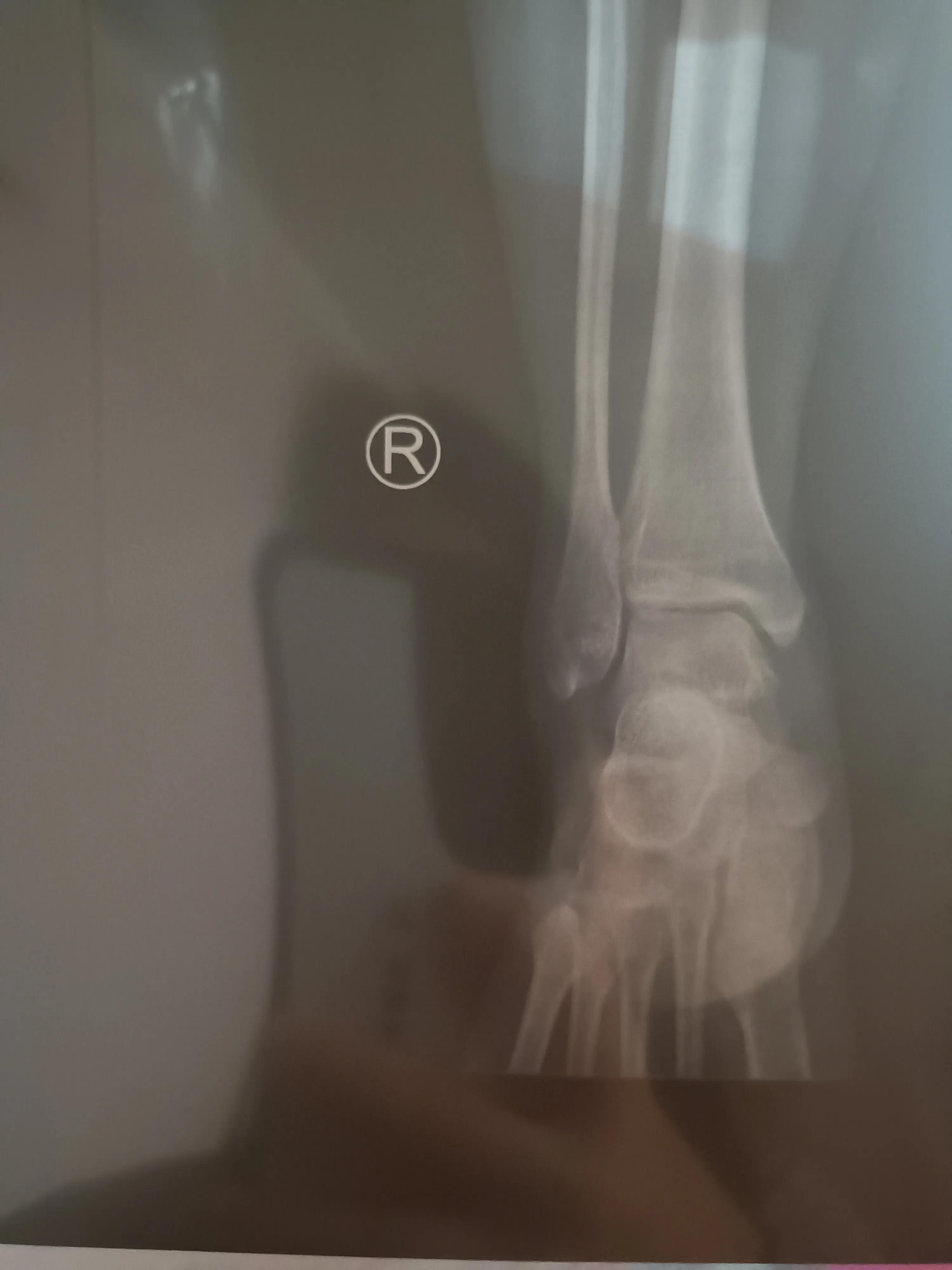 脚踝骨折一个月复查缝隙变大,左脚外踝撕脱骨折多久能恢复正常