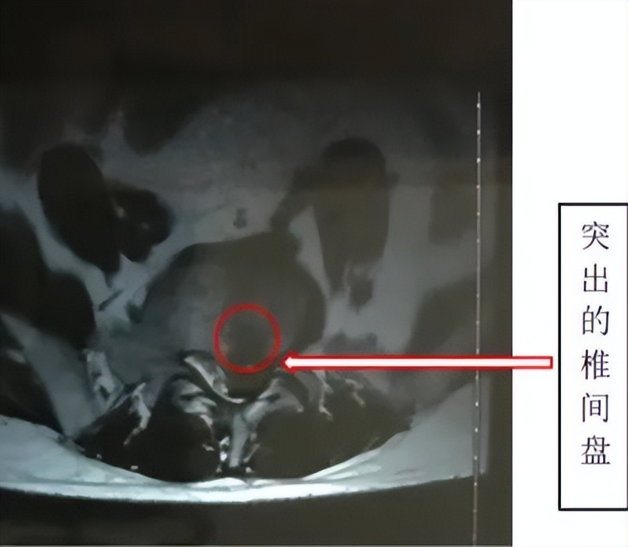 骨科必看的科普｜|得了腰椎间盘突出症，选择何种治疗方式才好？