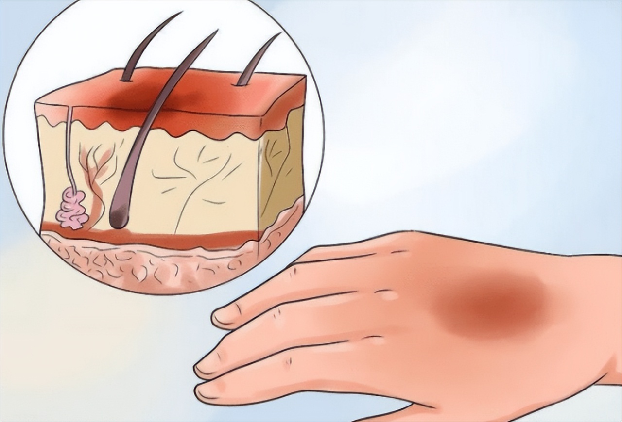 骨折后的手术疤痕怎么祛疤,儿童手术疤痕用什么祛疤药好