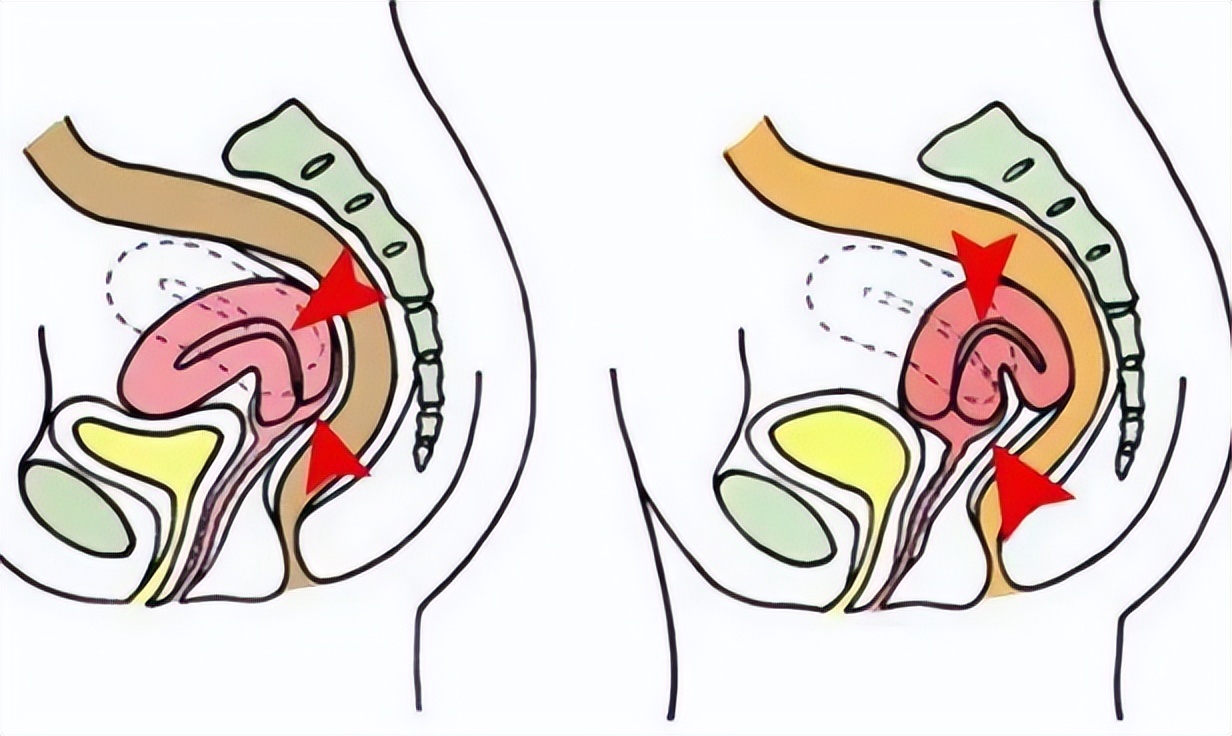 子宫后位会造成痛经吗,子宫后位趴着睡能矫正吗