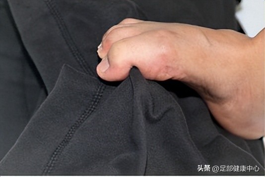 小脚趾往二脚趾方向歪怎么矫正,第三根脚趾头歪斜怎么矫正