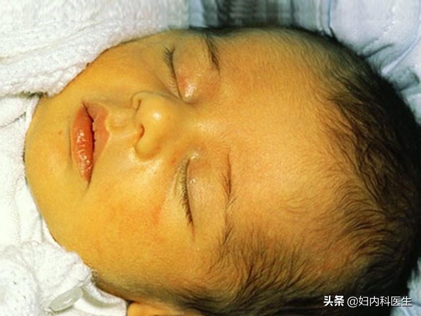 新生儿黄疸蓝光照射有什么危害,新生儿黄疸高20做蓝光有危害吗