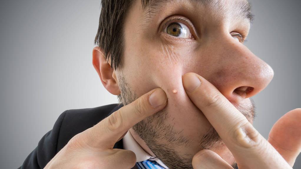 水杨酸适合爆痘的人使用吗,水杨酸抗痘