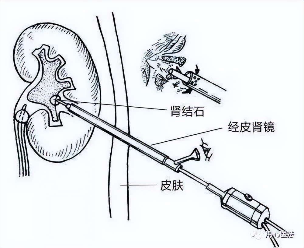 结石患者被医死怎么赔偿,结石引发休克多久会死