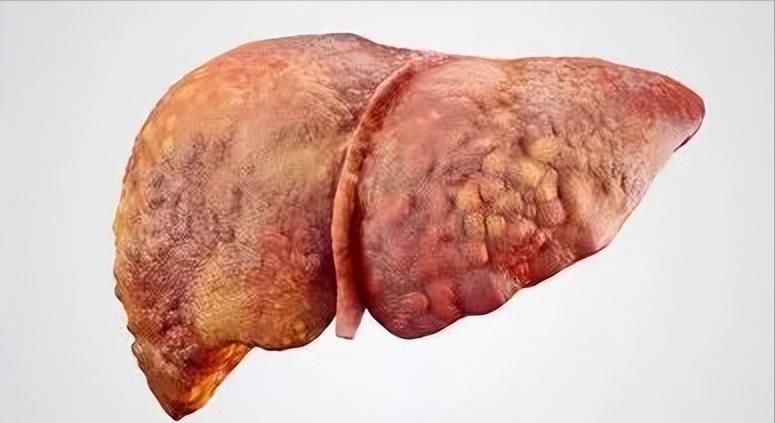 中国慢性乙肝临床治愈工程项目,慢性乙肝引起的脾大能治愈吗