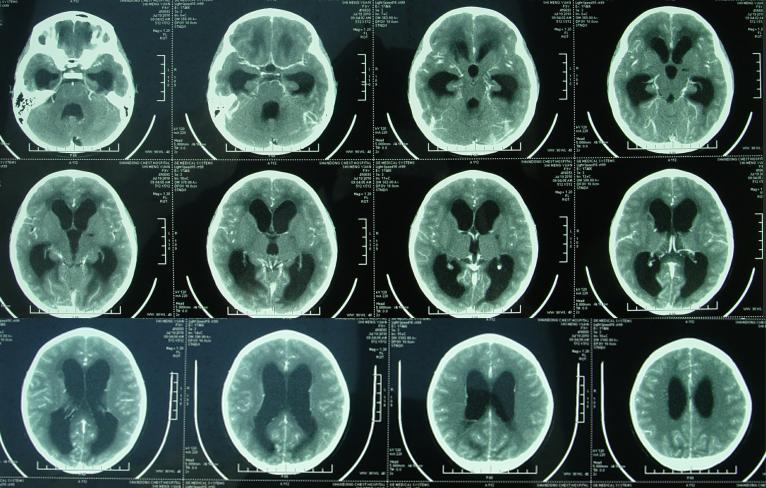 儿童结核脑膜炎脑积水,结核性脑膜炎脑积水如何引起