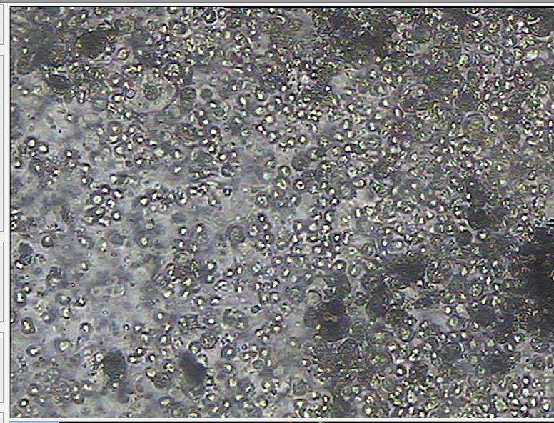 前列腺常规检查报告单正常,前列腺核磁共振报告单怎么解读