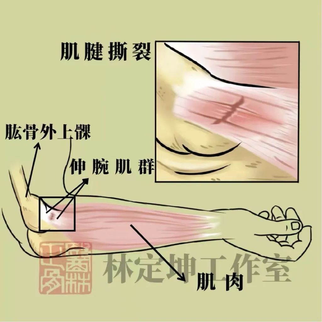 手肘筋劳损最快恢复方法,肘关节错位中医正骨