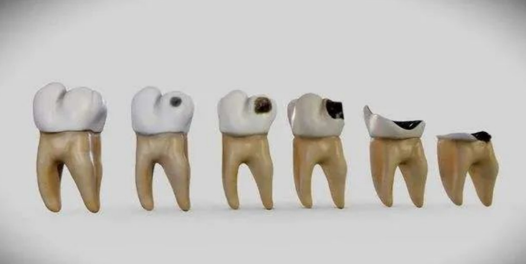 牙齿残冠残根必须拔牙吗,牙齿残根还能根管治疗吗