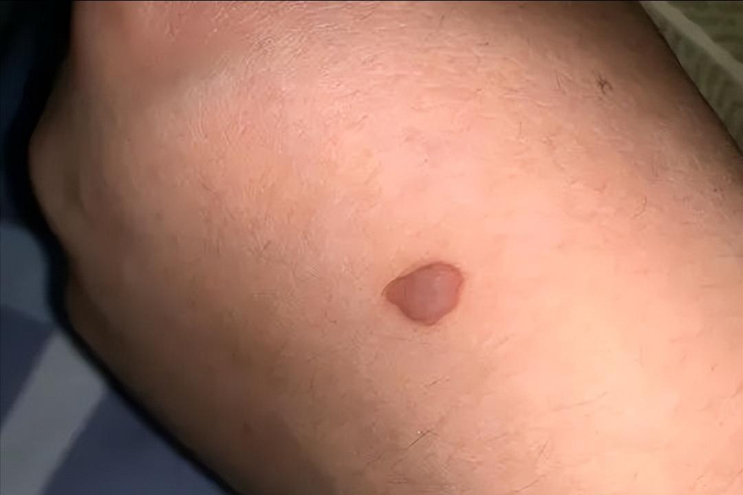 hpv和艾滋病怎么传染,hpv和疣有什么关系