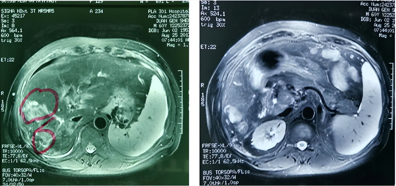 放疗肝内胆管细胞癌能治好吗,放疗治疗肝门静脉癌栓