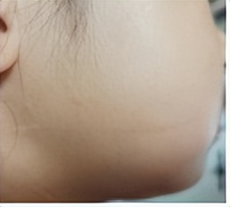 最难愈合的疤痕,无法治愈的疤痕