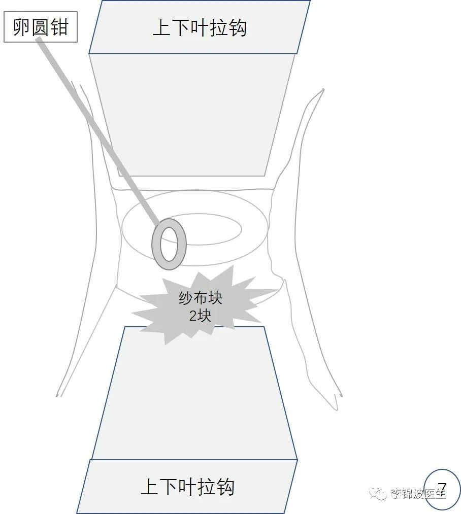 拆除高位宫颈环扎线的步骤和注意事项
