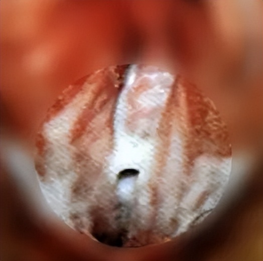 孕期阴道炎最好的治疗方法,孕期阴道炎有什么妙招