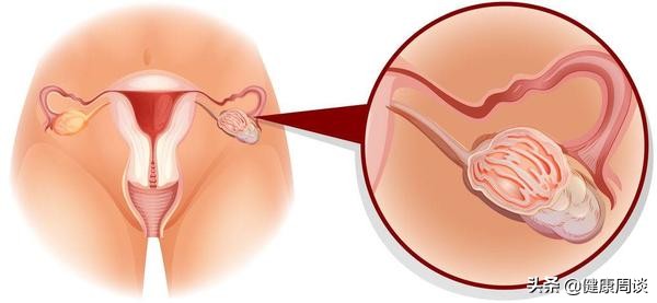 体检发现囊肿身体会出现什么症状,附件长囊肿有什么症状
