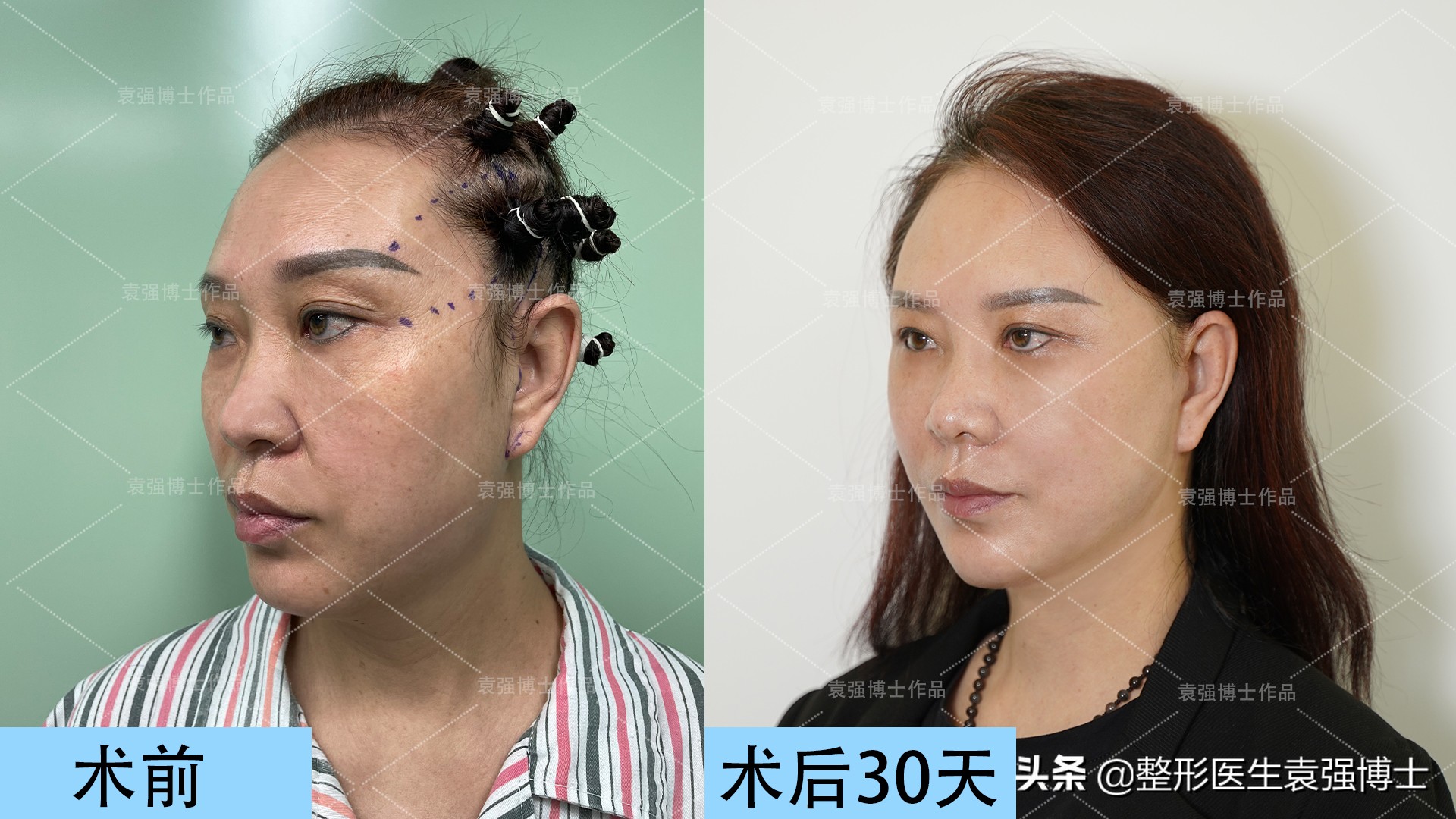40岁女人脸要怎么保养去法令纹,40岁男士法令纹最新消除法