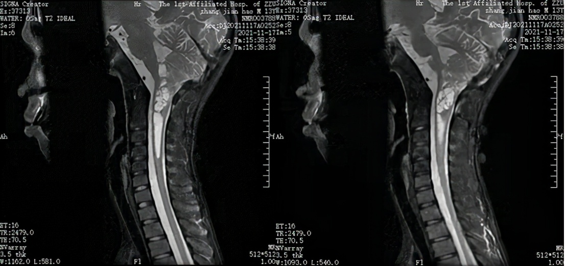 听神经瘤郑大一附院,北京中医治疗脑干胶质瘤
